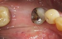 Vor Implantation