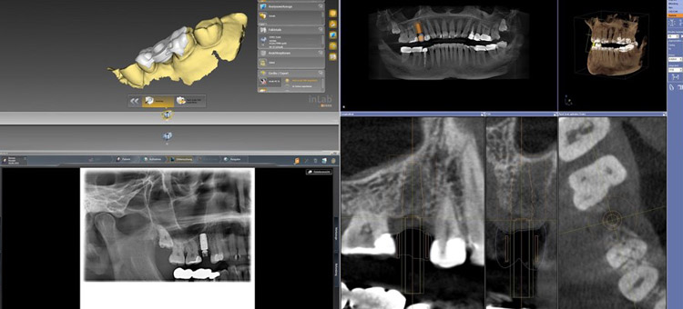 Integrierte Implantologie (CEREC® meets DVT)