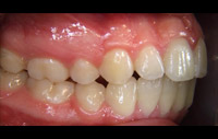 Veneers - Ansicht von rechts