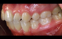 Veneers - Ansicht von links